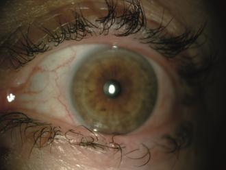 BLEPHARITIS